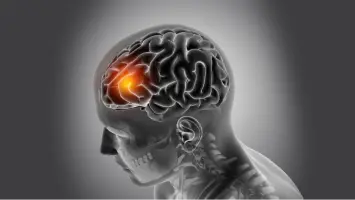 UAE Doctors Warn of Increasing Stroke Cases Among Younger Patients