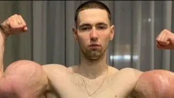 شاب روسي يتعرض لفشل كلوي بعد تحد رياضي مفرط