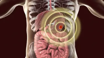 ذكاء اصطناعي جديد يساعد على اكتشاف سرطان المعدة مبكراً