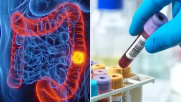 اختبار دم جديد يكشف سرطان القولون بدقة في مراحله المبكرة