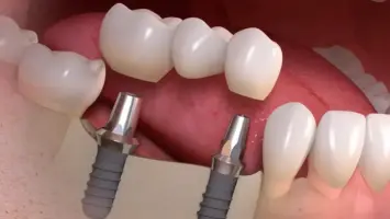 زيركون الأسنان: سر الابتسامة القوية والجذابة