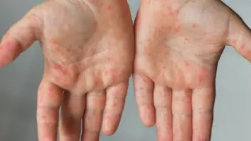 Canada Records Highest Measles Cases in Americas, Surpassing 4,500