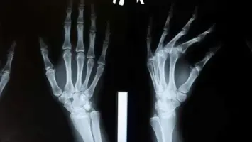 مادة لاصقة مبتكرة تسرع شفاء كسور العظام في دقائق