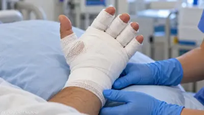 جراحة لإعادة توصيل أربعة أصابع مبتورة في مستشفى جامعة أسيوط
