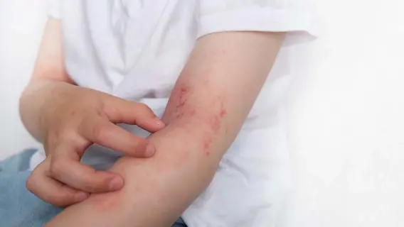 UAE Doctors Warn of Increasing Skin Breakouts and Dryness During Winter