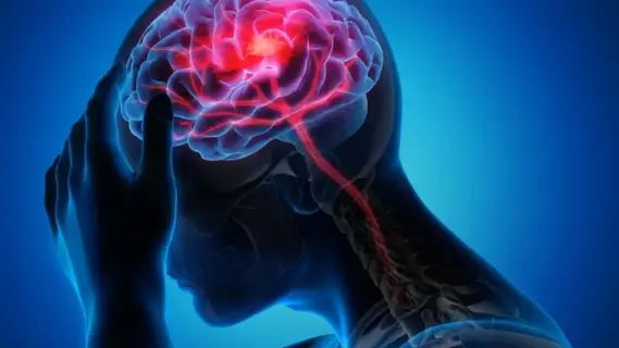 زيادة حالات السكتات الدماغية بسبب تمزق الشريان العنقي بنسبة 500% خلال 15 عامًا