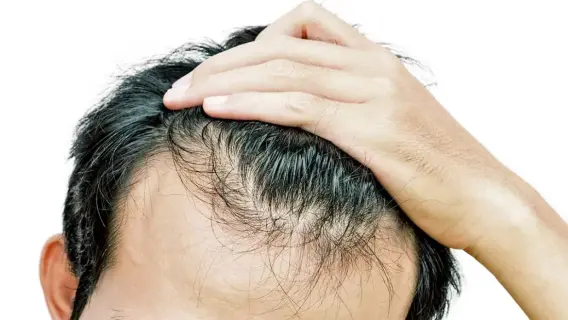 تحذيرات متزايدة من آثار "فيناسترايد" على الصحة الجنسية