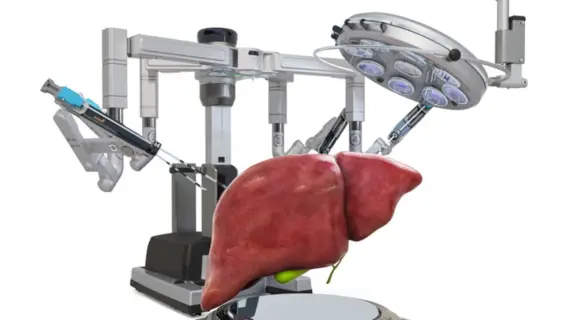 إطلاق الجراحة الروبوتية لمعالجة أمراض الكبد في لبنان