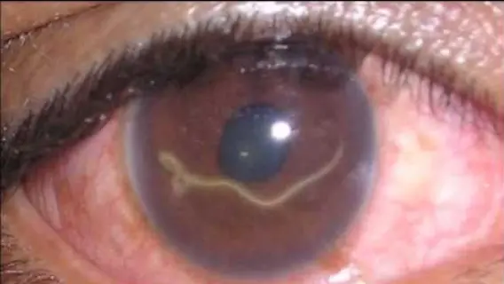 اكتشاف دودة في عين رجل بعد أشهر من ضبابية الرؤية