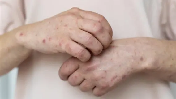 الصحة العالمية: أول لقاحات فيروس جدري القرود في طريقها للوصول إلي الكونغو